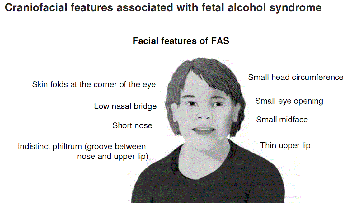 Illustration des caractéristique faciale d'un enfant atteint de syndrome d'alcoolisation fœtale. - Wikipedia