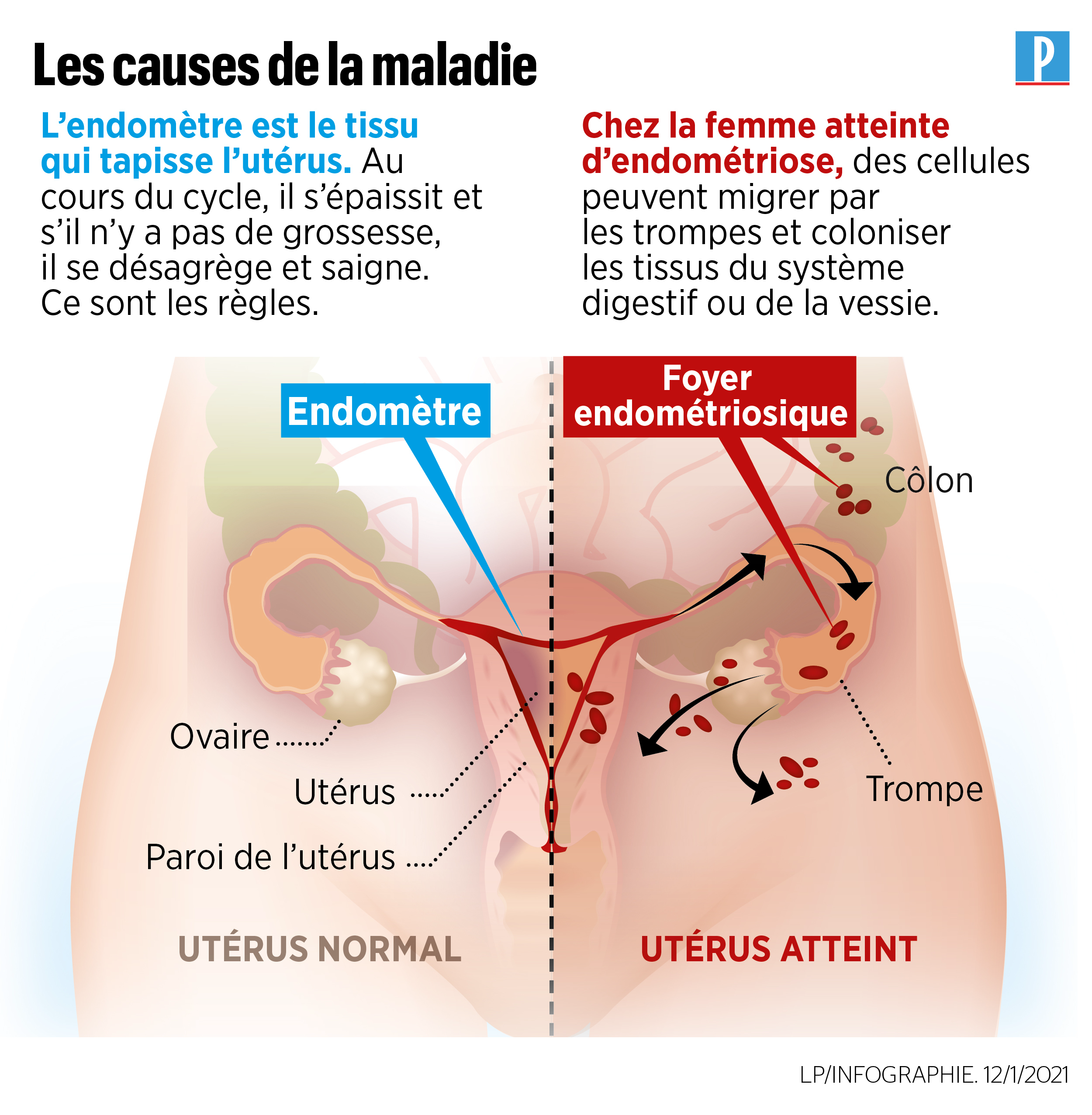 Illustration - comprendre l'endométriose. - Le parisien