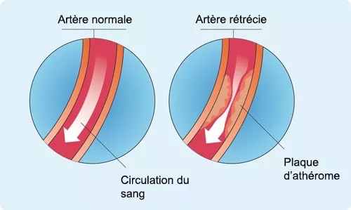 Différences entre une artère normale et une artère rétrécie par l'athérome